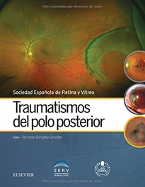 Books Frontpage Traumatismos del polo posterior